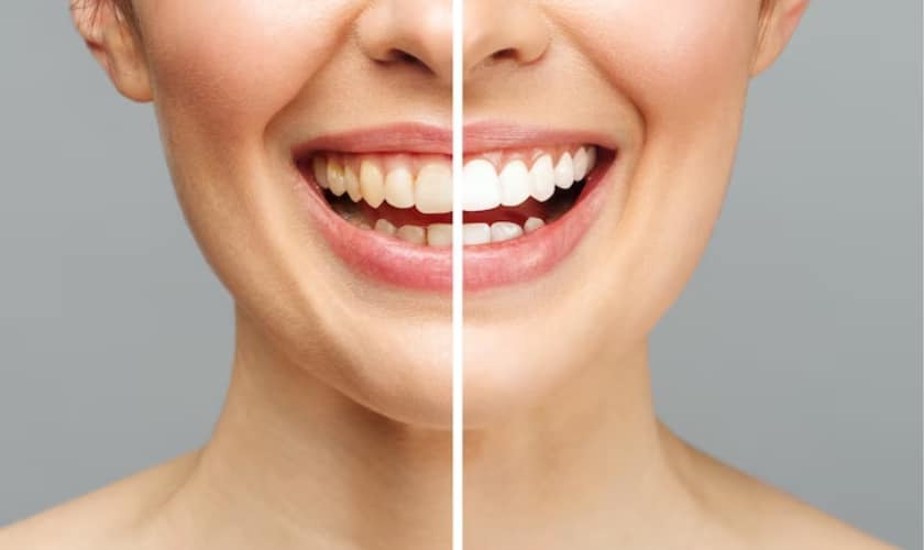 Are Teeth Whitening Treatments Safe for Your Dental Health?
