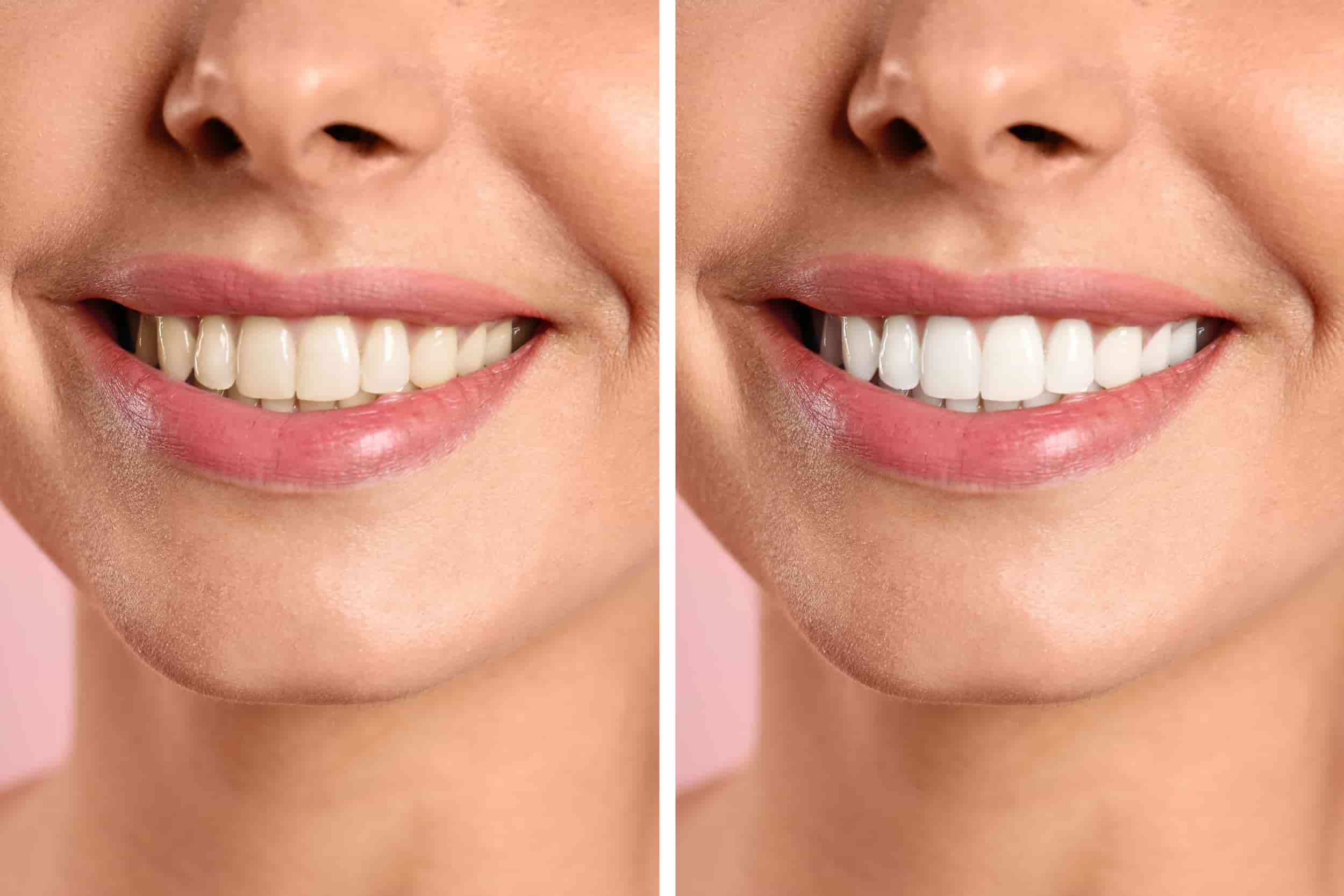 Brighten Your Smile: Exploring the Best Teeth Whitening Methods and Their Impact on Dental Health
